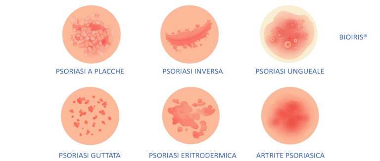 La psoriasi: una malattia cronica della pelle.